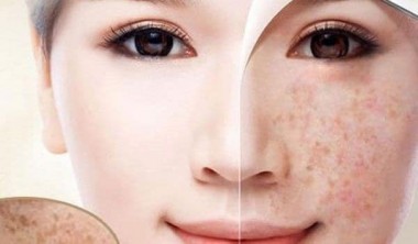 Bật mí cách sử dụng serum trị nám Onasa hiệu quả nhất